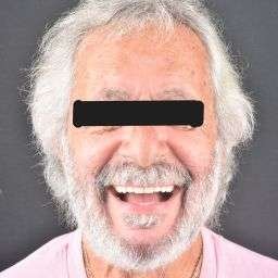 PROTHESE ZIRCONE APRES x