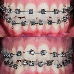 Fixed orthodontic appliances to straighten crooked or misaligned teeth. Before and after photo. Selective focus.